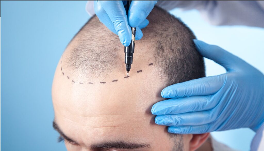 hair transplant london